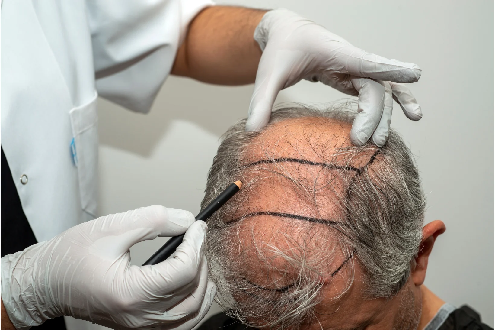 Hair graft placement