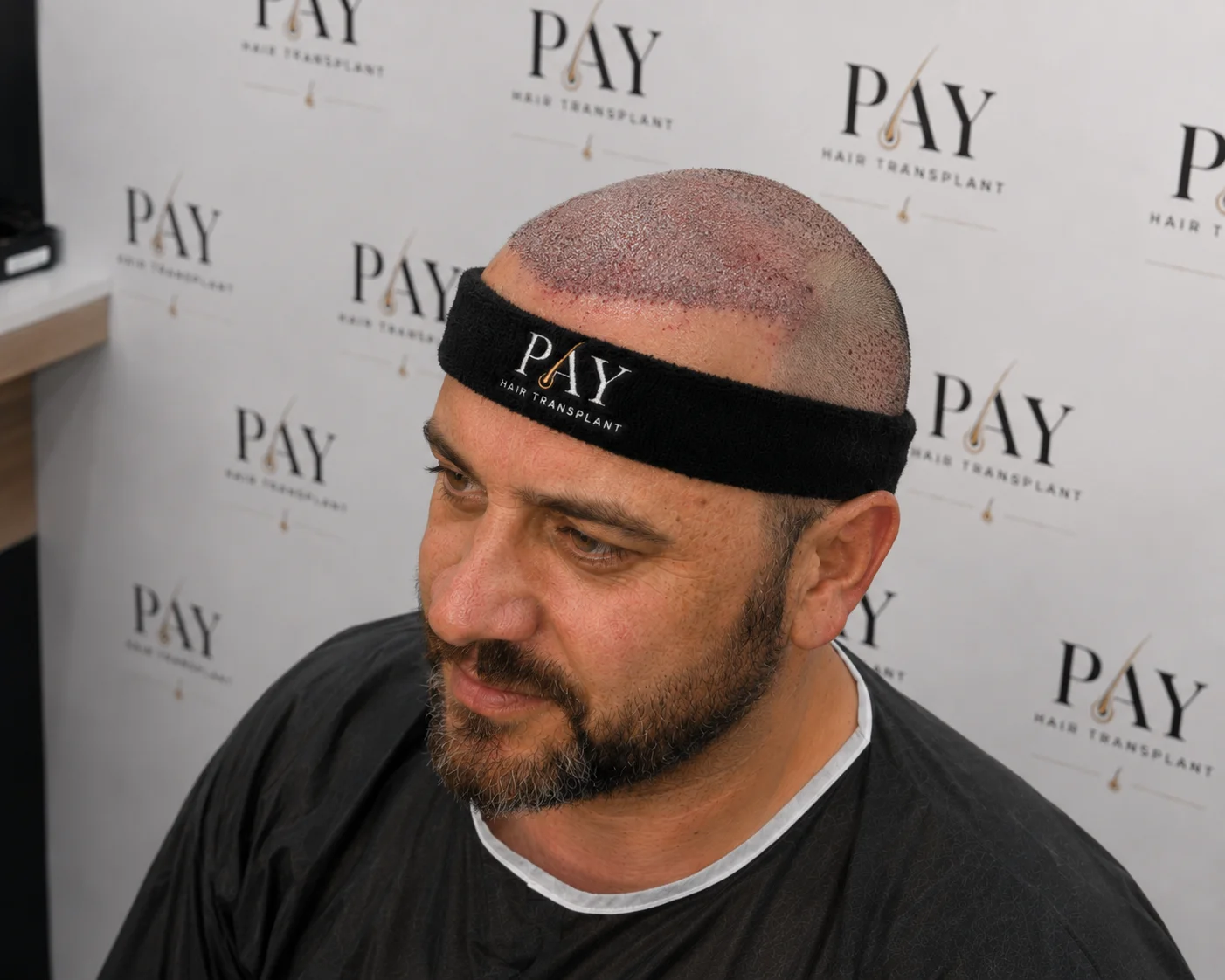 FUE hair transplantation in a clinical room