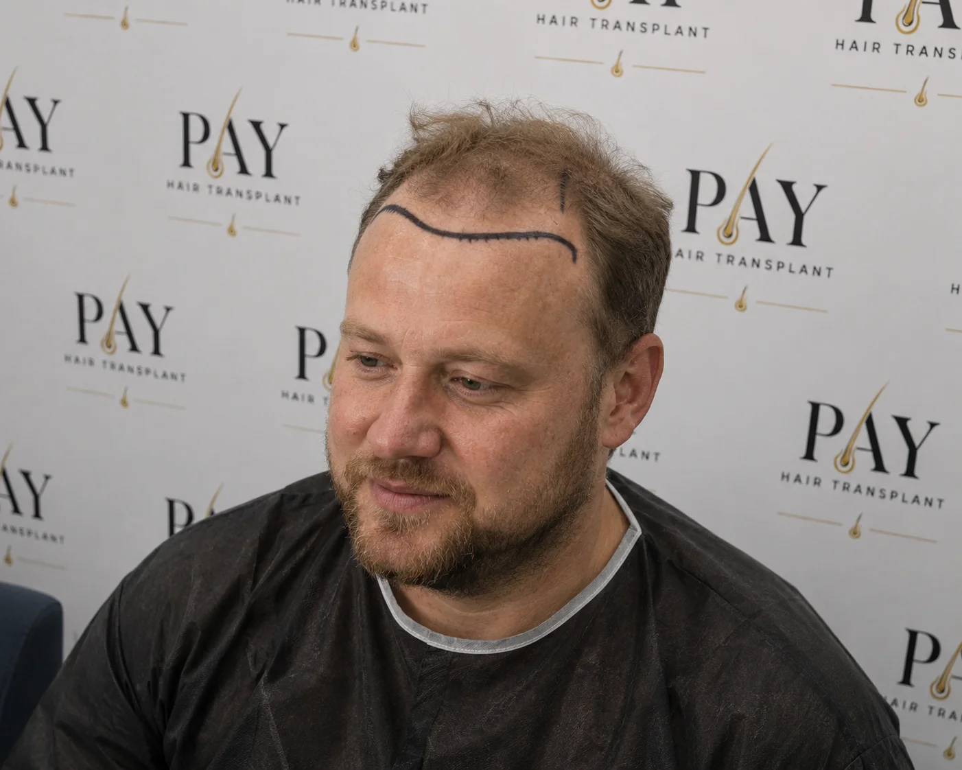 hair transplantation procedure