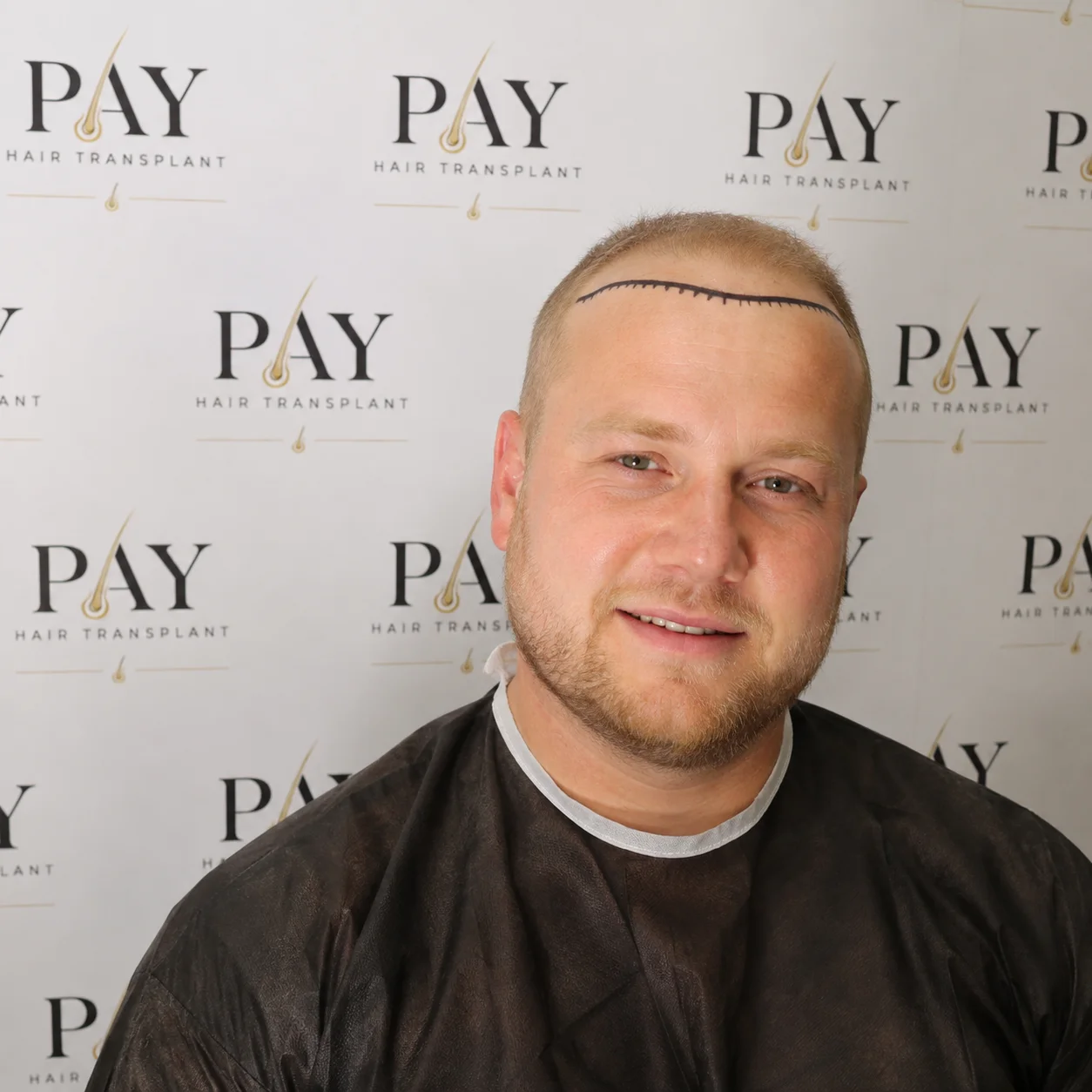 before hair transplantation