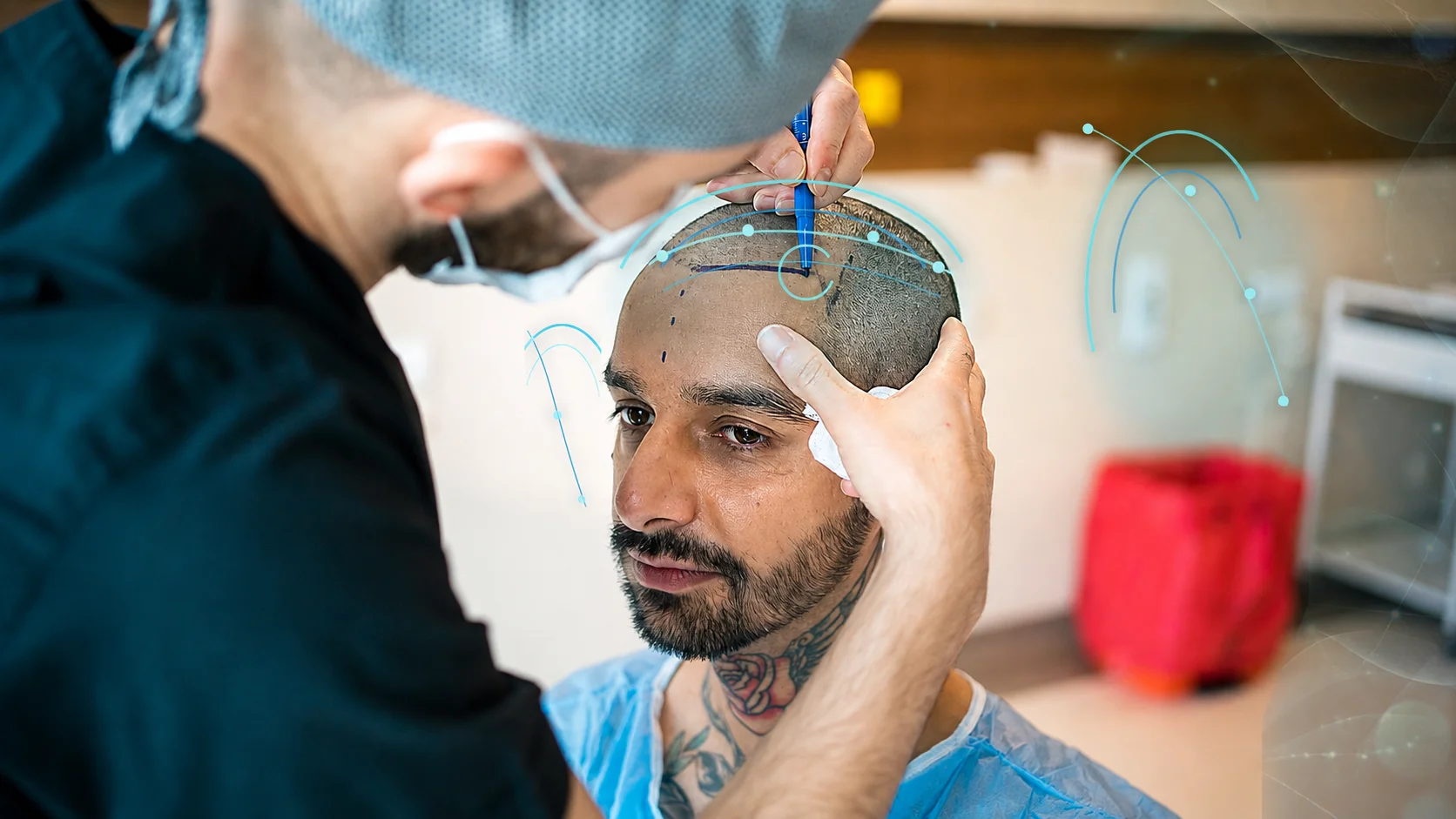 Hair transplantation team during a procedure